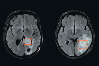 Brain tumor detection